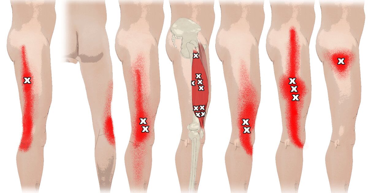 What Are Trigger Points? - Yoganatomy